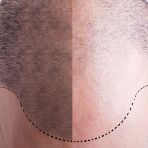 4 tips for a successful fue hair transplant